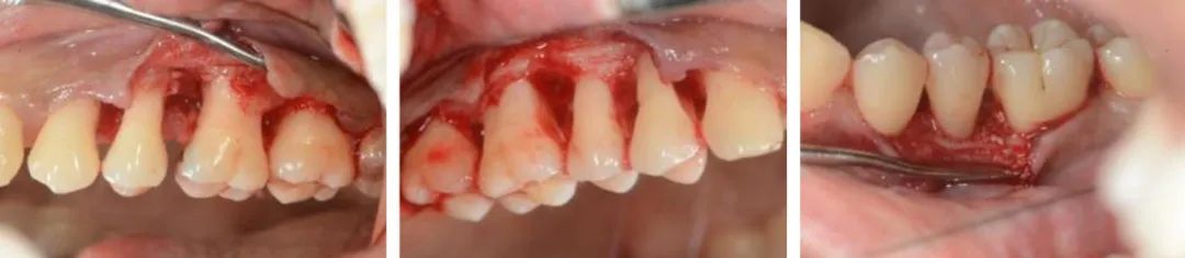 矫正牙齿还要拔牙,以后牙齿好松动吗，从正畸学视角看松动牙的拔与留——施捷主任医师插图11