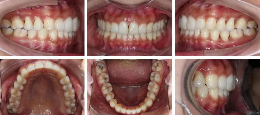 矫正牙齿还要拔牙,以后牙齿好松动吗，从正畸学视角看松动牙的拔与留——施捷主任医师插图13