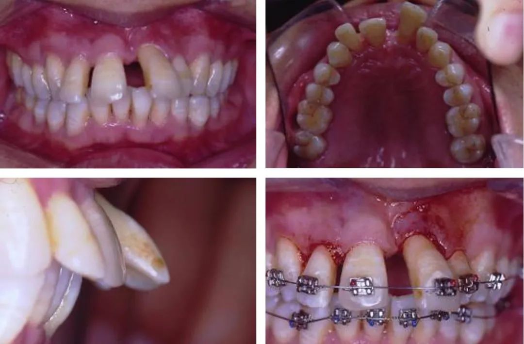 矫正牙齿还要拔牙,以后牙齿好松动吗，从正畸学视角看松动牙的拔与留——施捷主任医师插图15